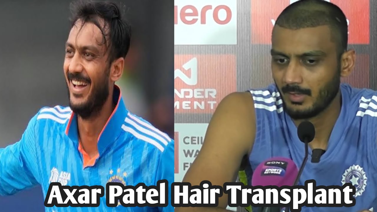 Axar Patel Hair Transplant